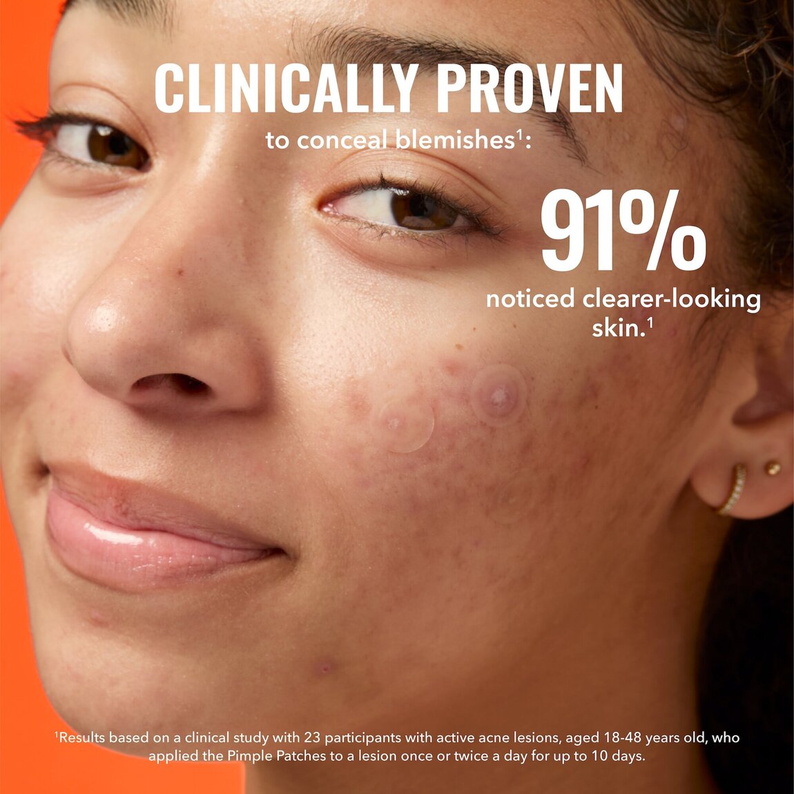 pimple-patches-u6 zb_p.jpg