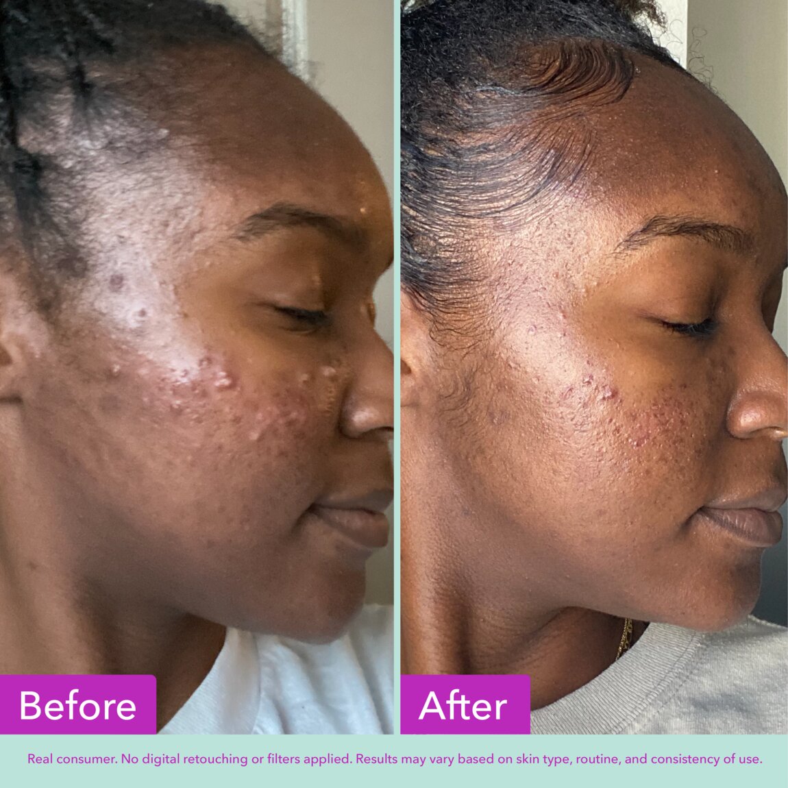 acne-foaming-cleanser-a7 zb_p.jpg